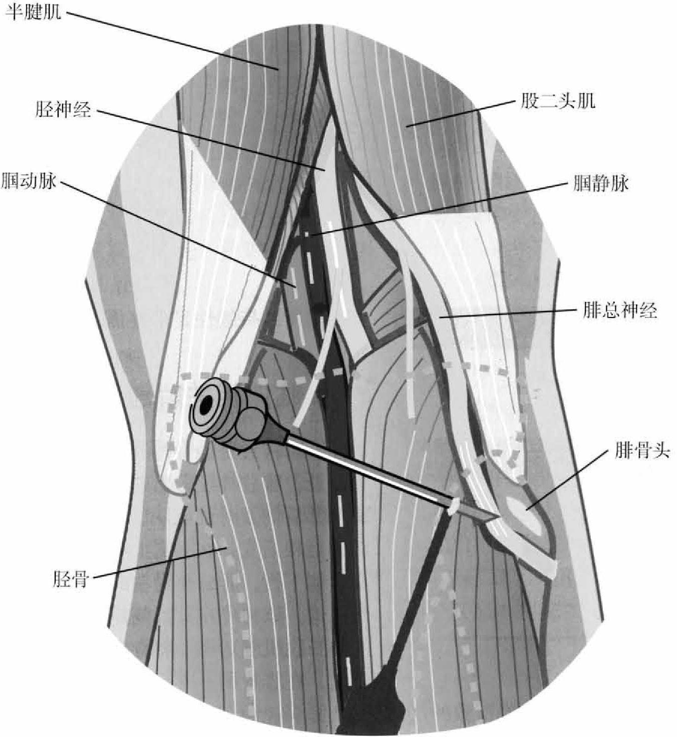 第六節(jié) 腓總神經(jīng)射頻鎮(zhèn)痛治療